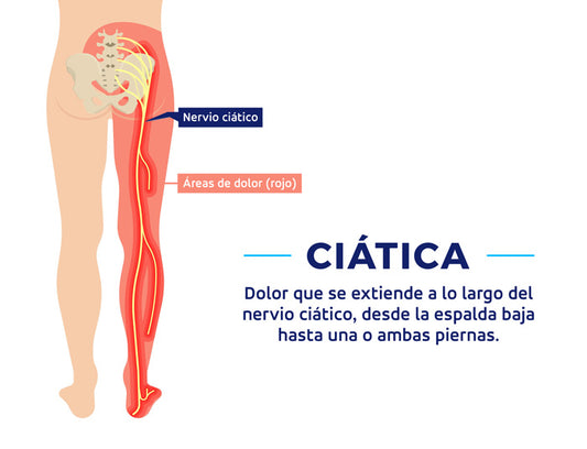 CIATICA ¿QUE ES Y COMO TRATARLA?